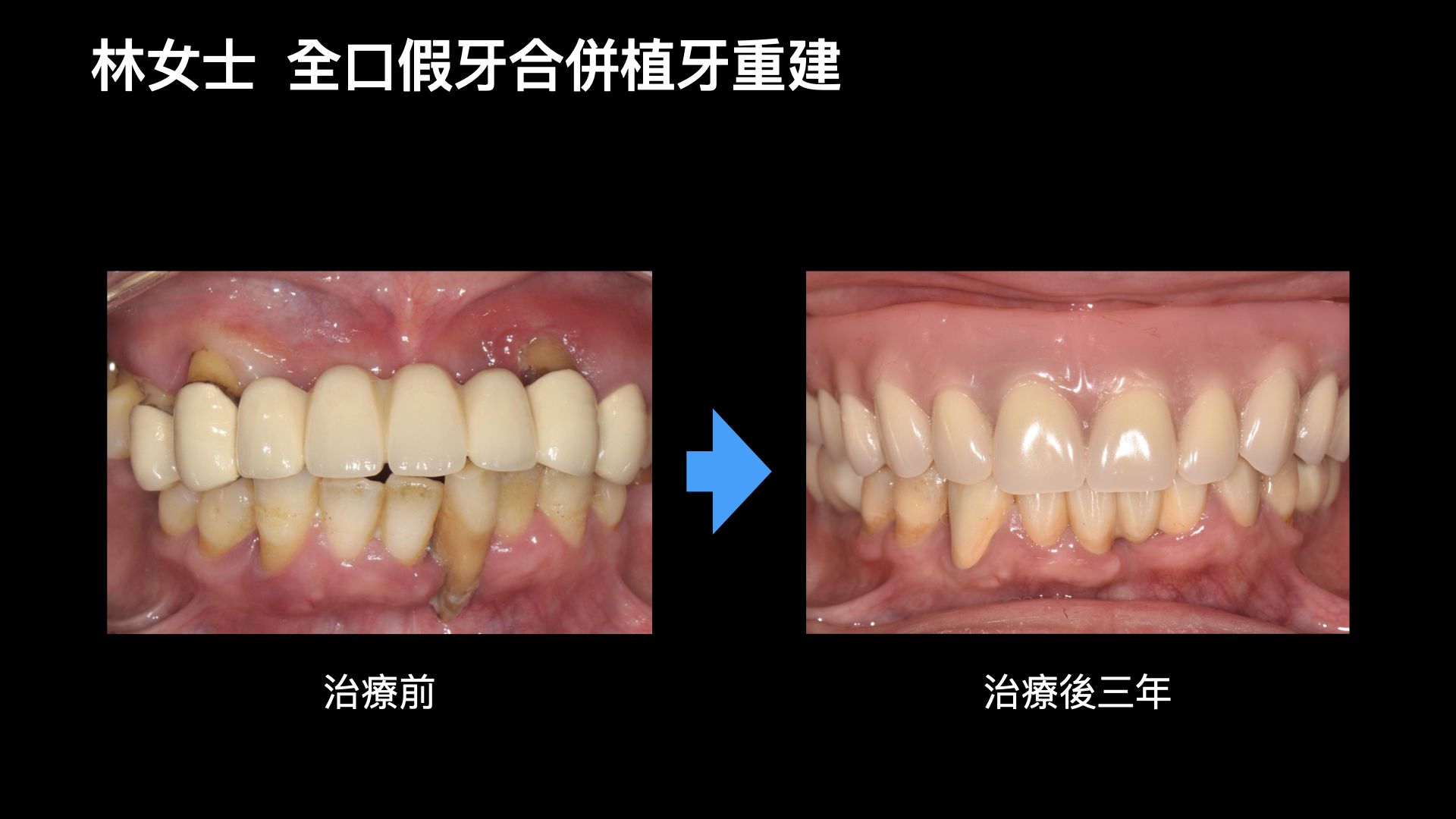 全口重建：固定假牙＋活動假牙 - 品硯牙醫